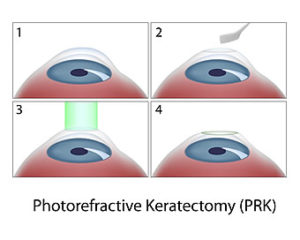 Photorefractive Keratectomy (PRK) Torrance