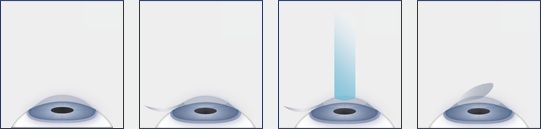 LASIK procedure illustration