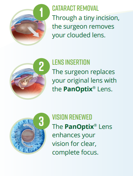 PanOptix Process